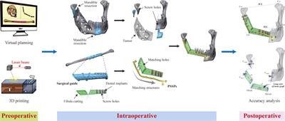 Editorial: Virtual surgical planning and 3d printing in head and neck tumor resection and reconstruction